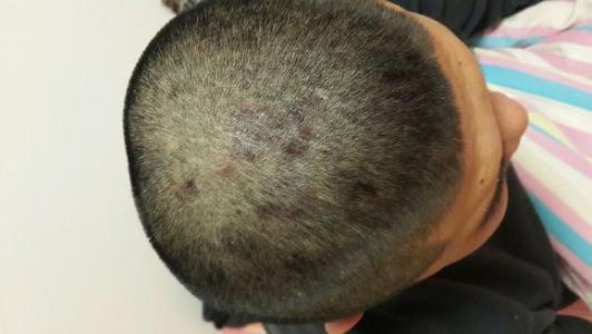 医生解析头癣的症状
